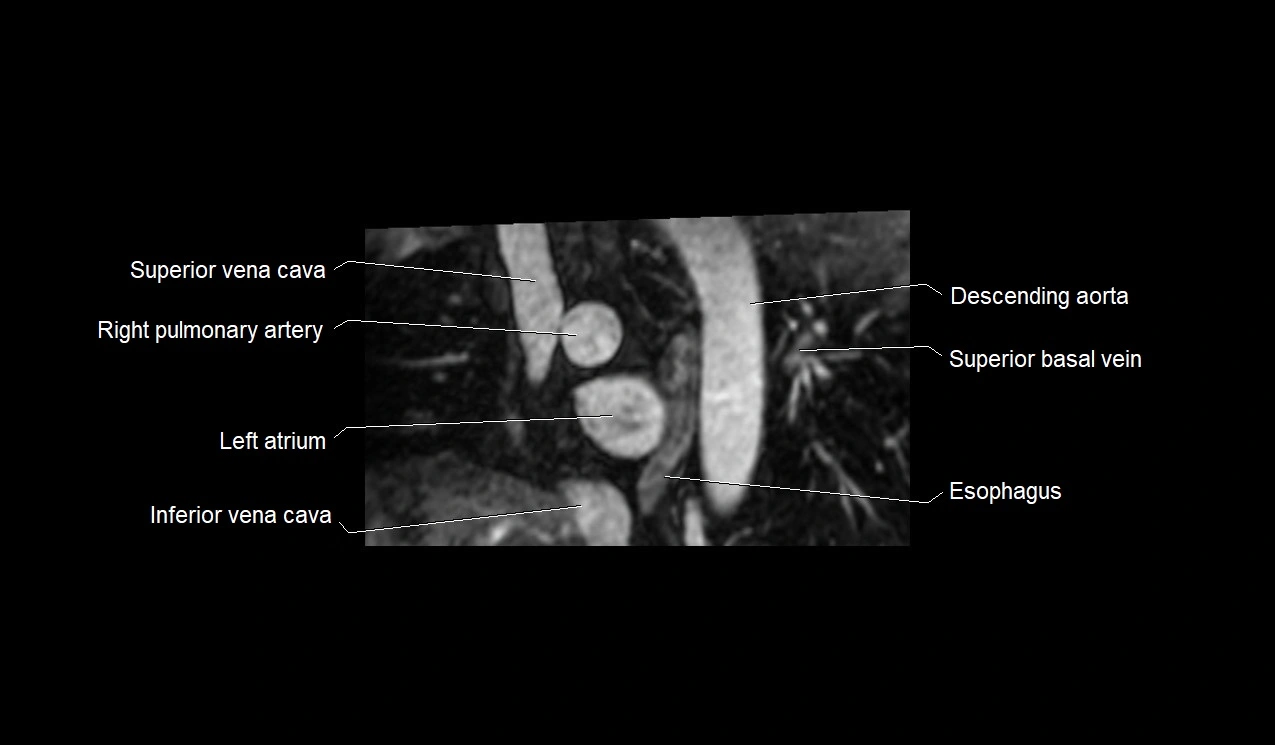 MRI heart and coronary arteries short axis anatomy image 5.webp